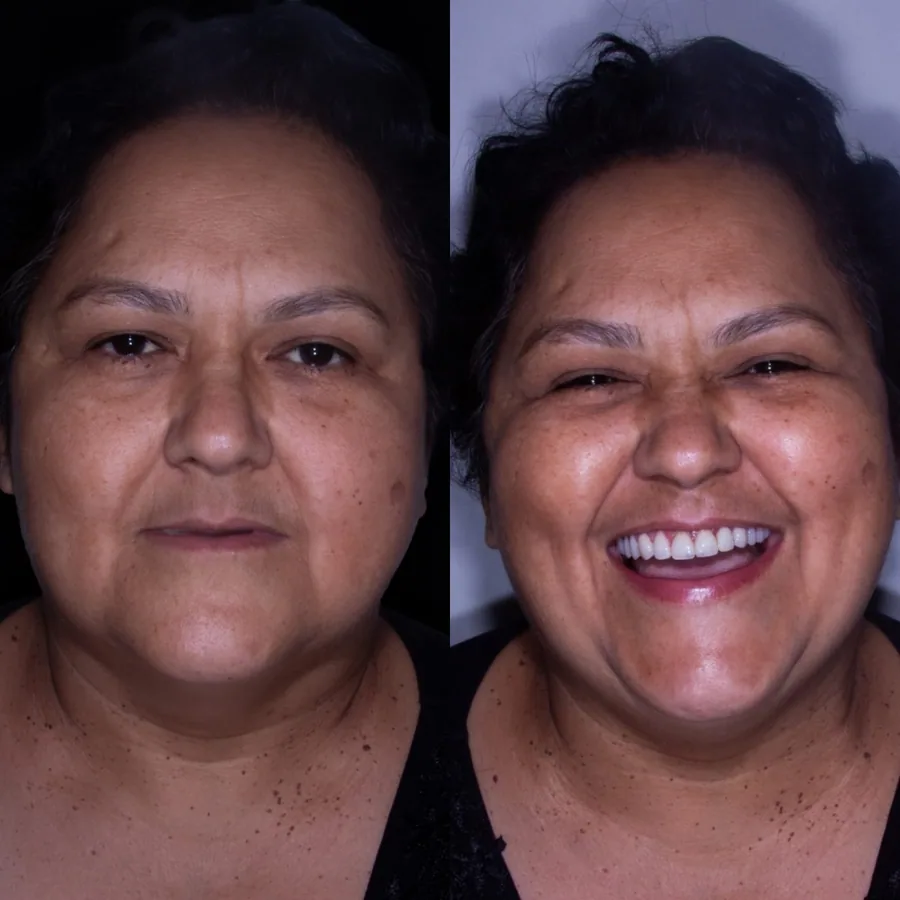 Paciente do Instituto Line Clinic antes e depois do tratamento, voltando a sorrir abertamente