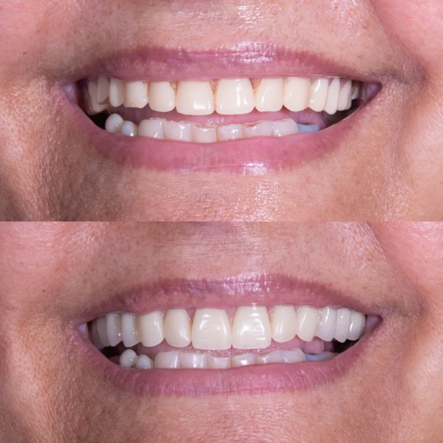 Paciente do Instituto Line Clinic antes e depois do alinhamento e da reabilitação dos dentes