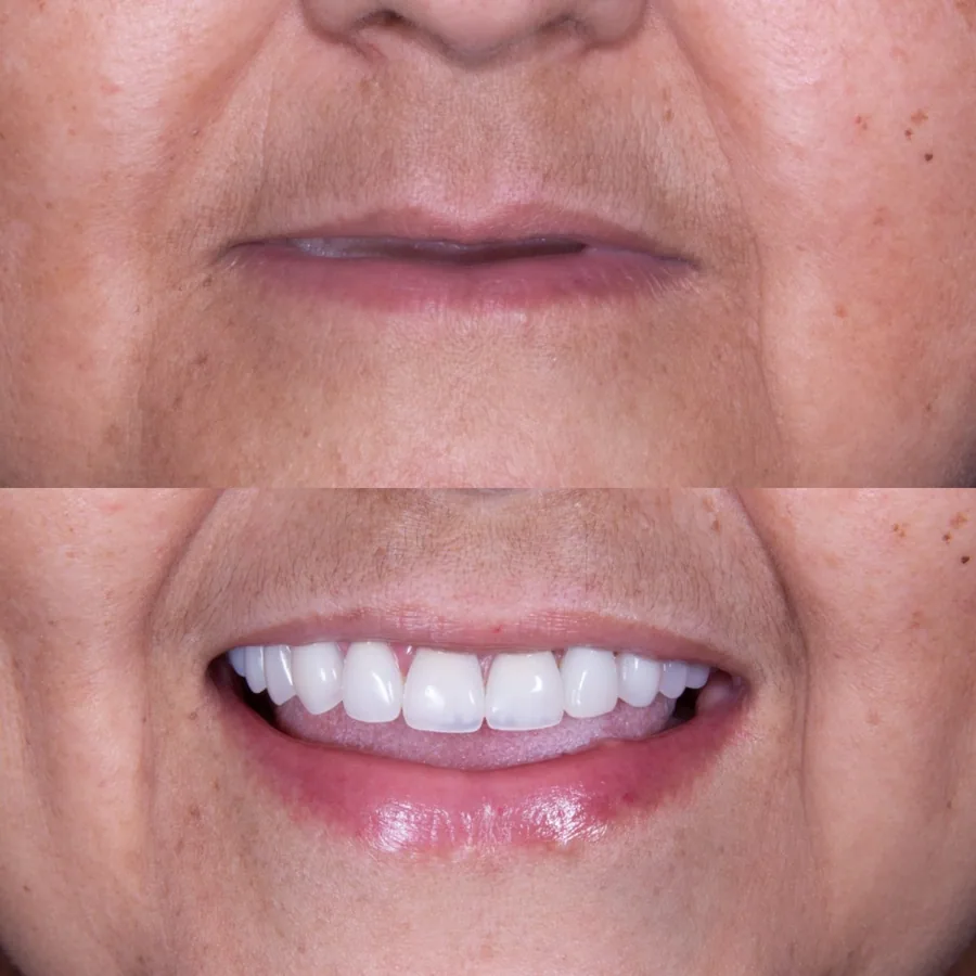 Paciente do Instituto Line Clinic antes e depois de recuperar os dentes da arcada superior