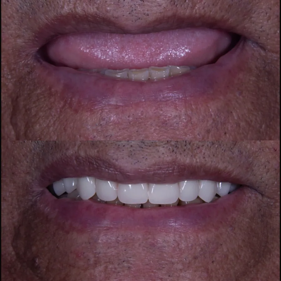 Paciente do Instituto Line Clinic antes e depois do tratamento com dentes fixos sobre implantes
