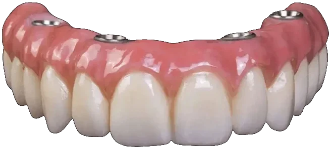 Prótese protocolo de dentes fixos, parafusada sobre implantes