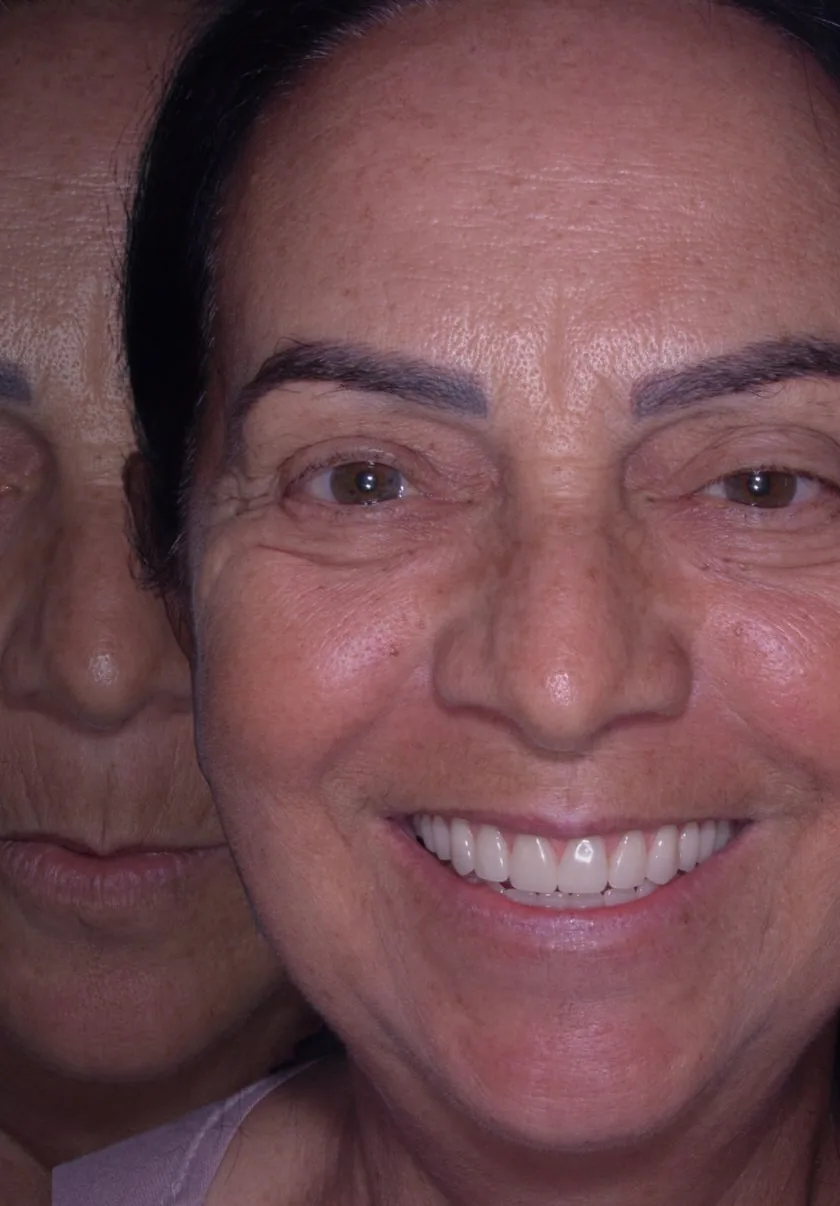 Paciente do Instituto Line Clinic sorrindo após a reabilitação com dentes fixos sobre implantes